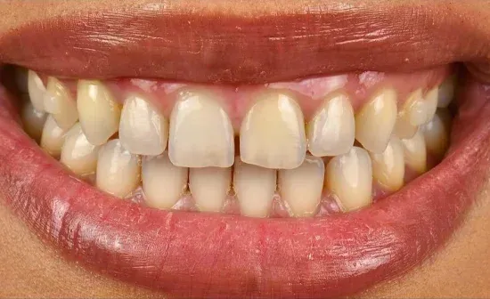 Smile before treatment, case one
