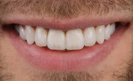 Smile after treatment, case two