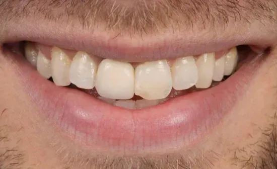 Smile before treatment, case two