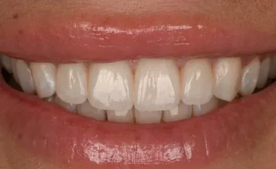 Smile after treatment, case three