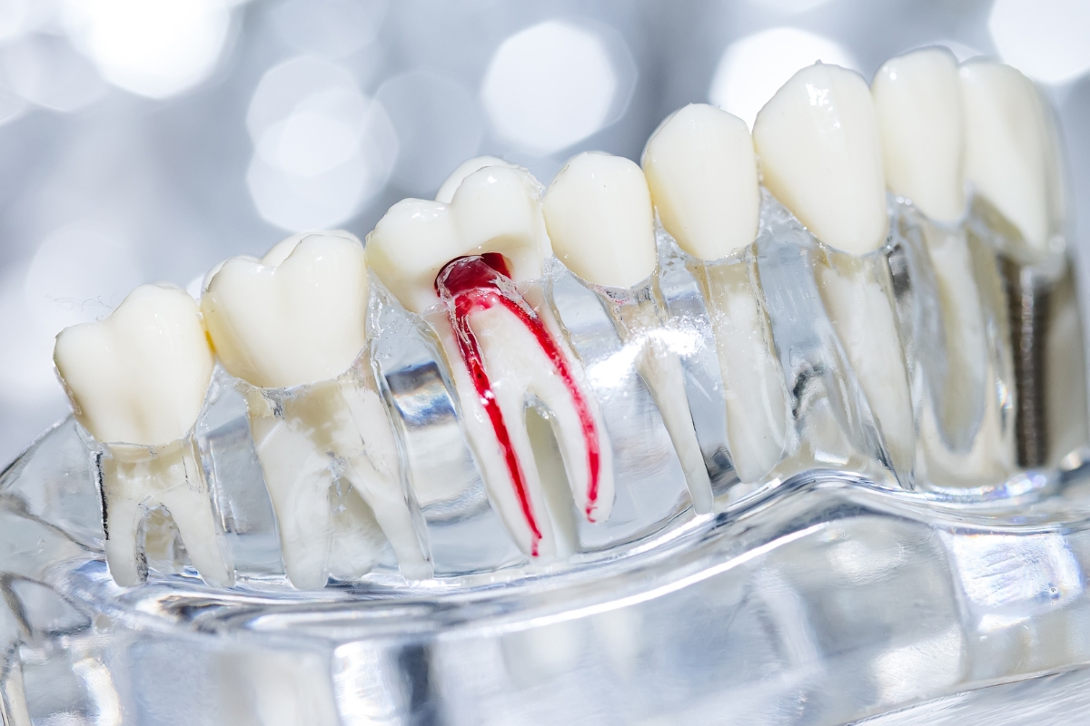 root canal therapy in Haymarket