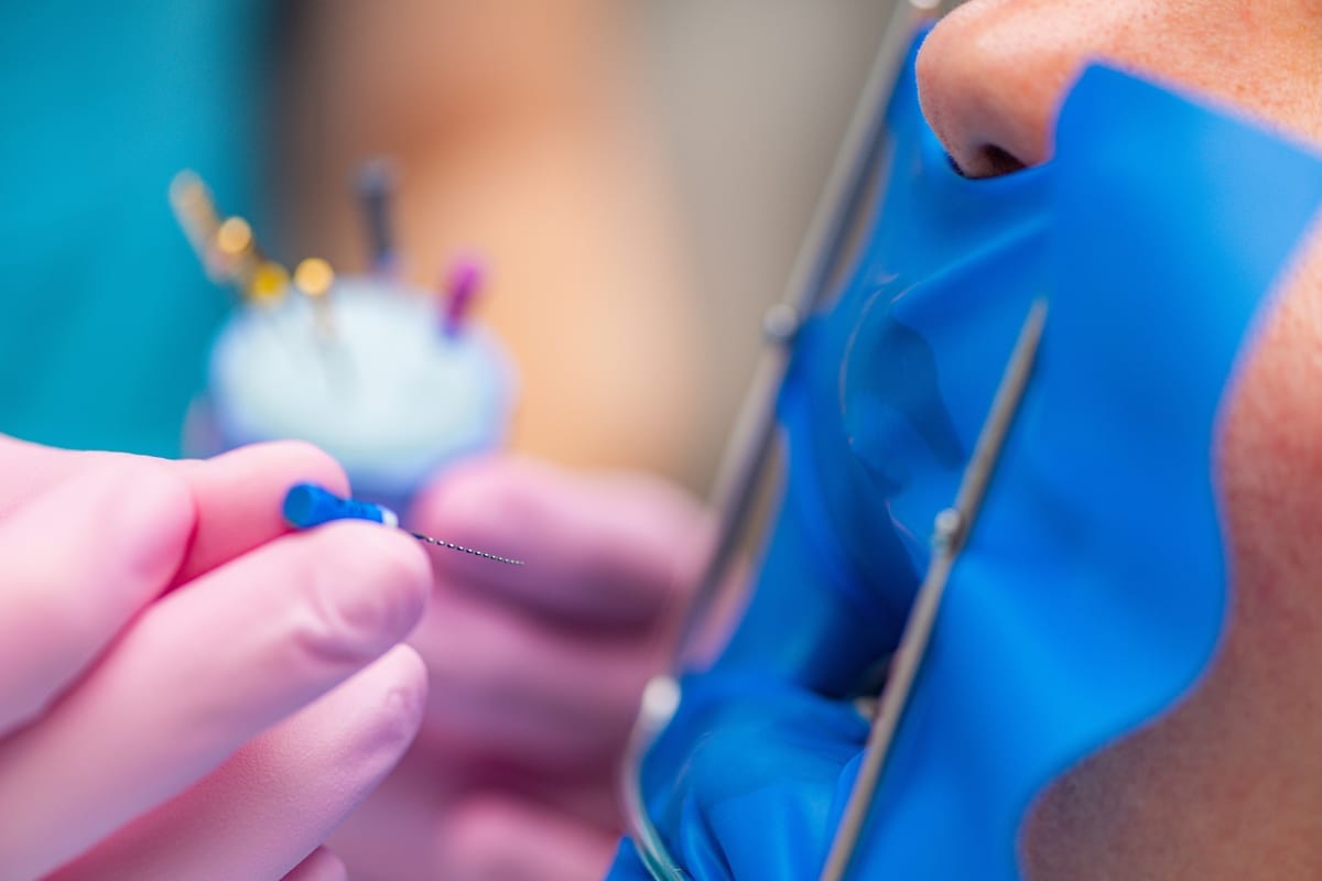 Root Canal Treatment in Linton Hall