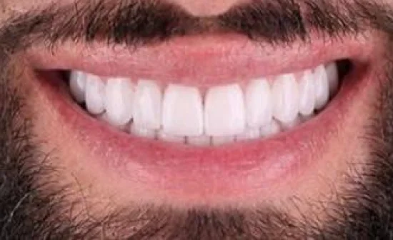 cosmetic dental veneers after