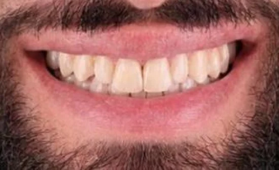 cosmetic dental veneers before
