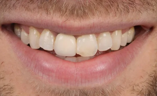 dental veneers before