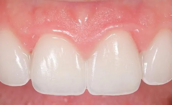 porcelain veneers after