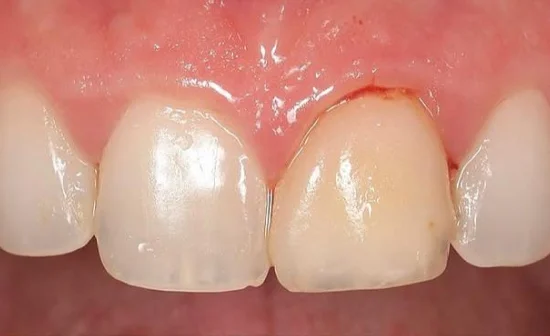 porcelain veneers before