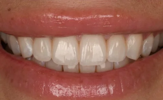 porcelain veneers smile after