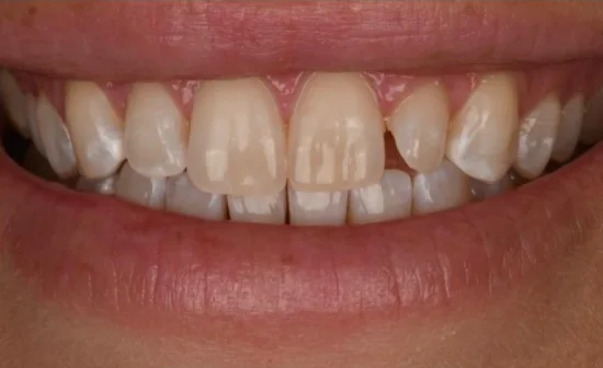 porcelain veneers smile before