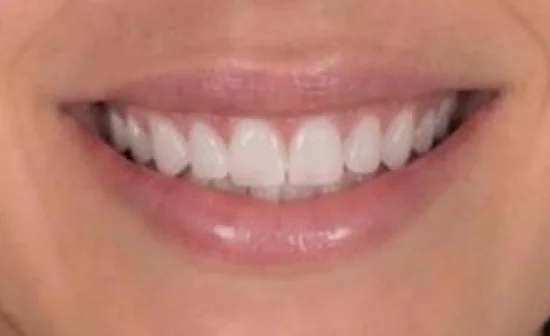 smile makeover after