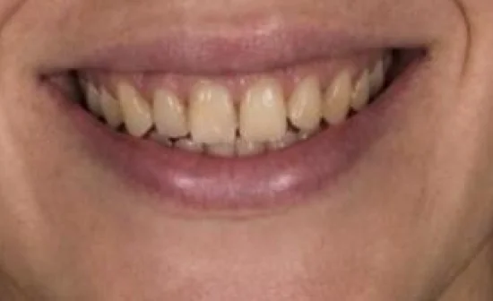 smile makeover before